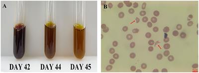 Case report: Decreased hemoglobin and multiple organ failure caused by ceftizoxime-induced immune hemolytic anemia in a Chinese patient with malignant rectal cancer